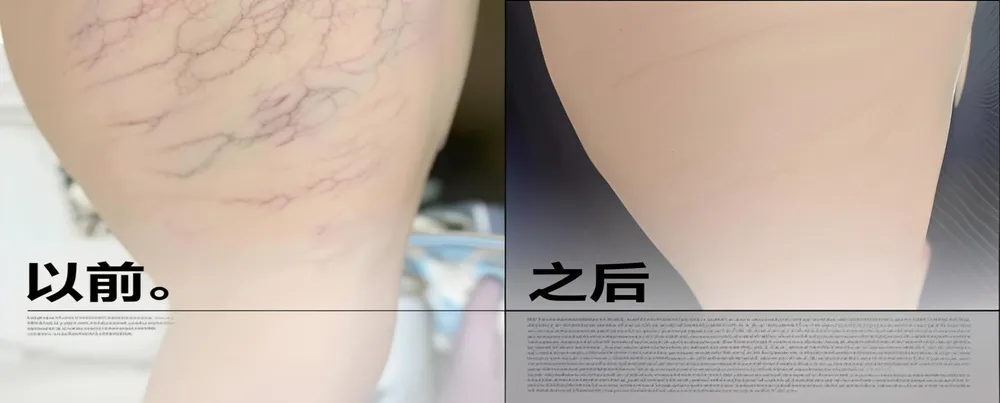 减少蜘蛛静脉