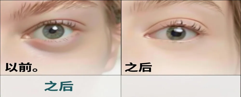 减少黑眼圈
