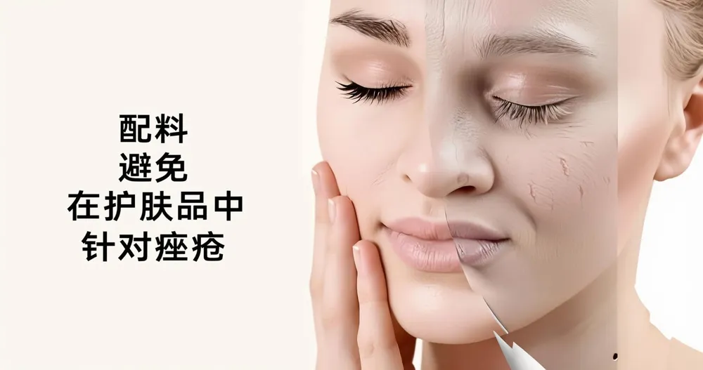 护肤中应避免的成分(针对痤疮)