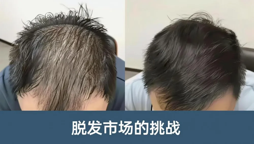 脱发市场面临的挑战